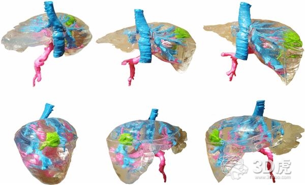 波蘭研究人員借FDM 3D打印機造低成本術前肝臟模型